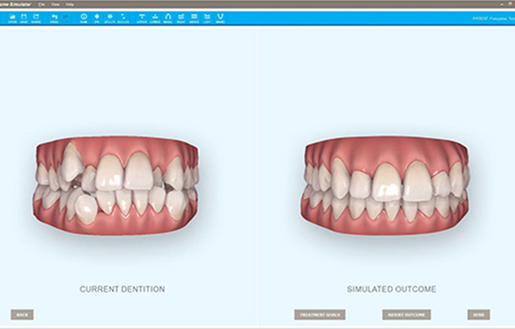 矯正後の歯ならびをシミュレーション